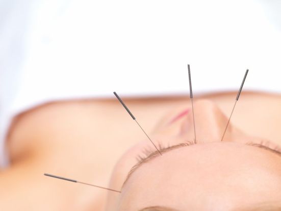 akupunktur-nadeln
